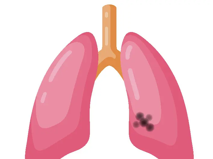 ccc lung cancer